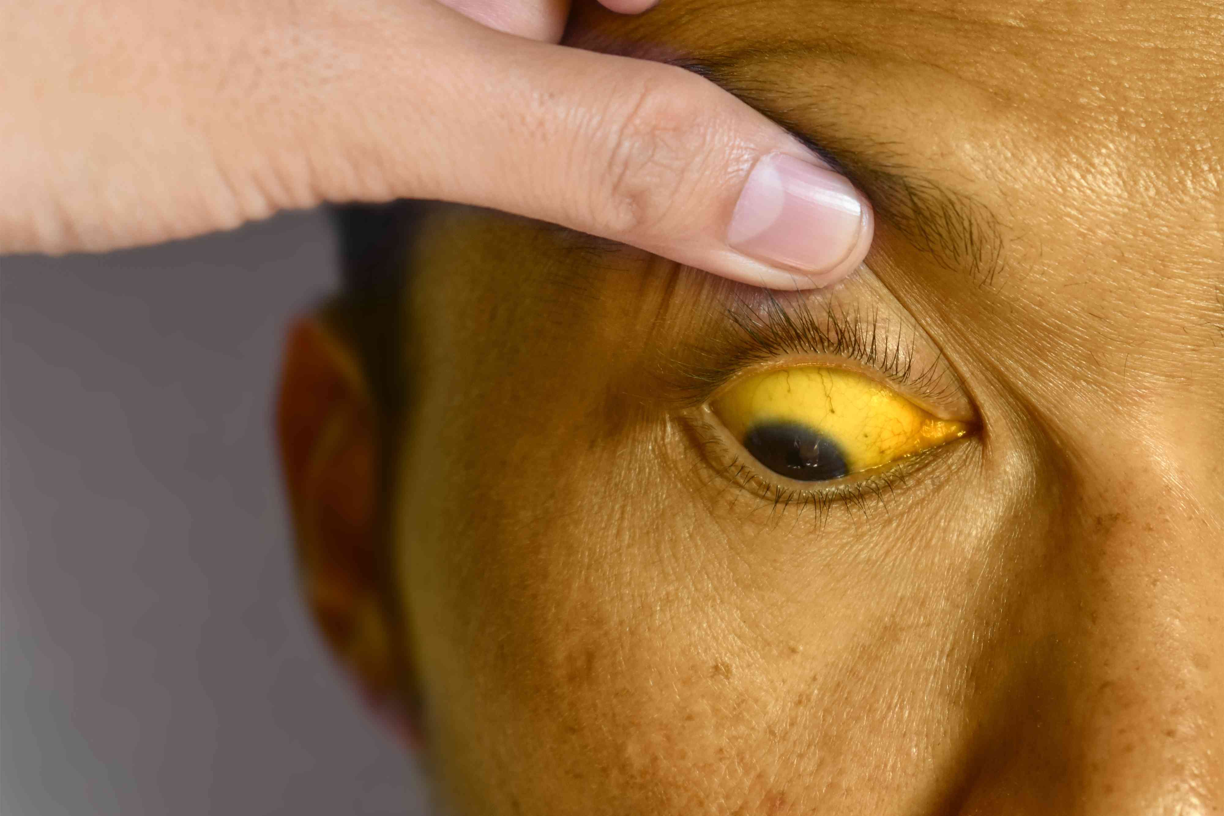 Jaundice Banner