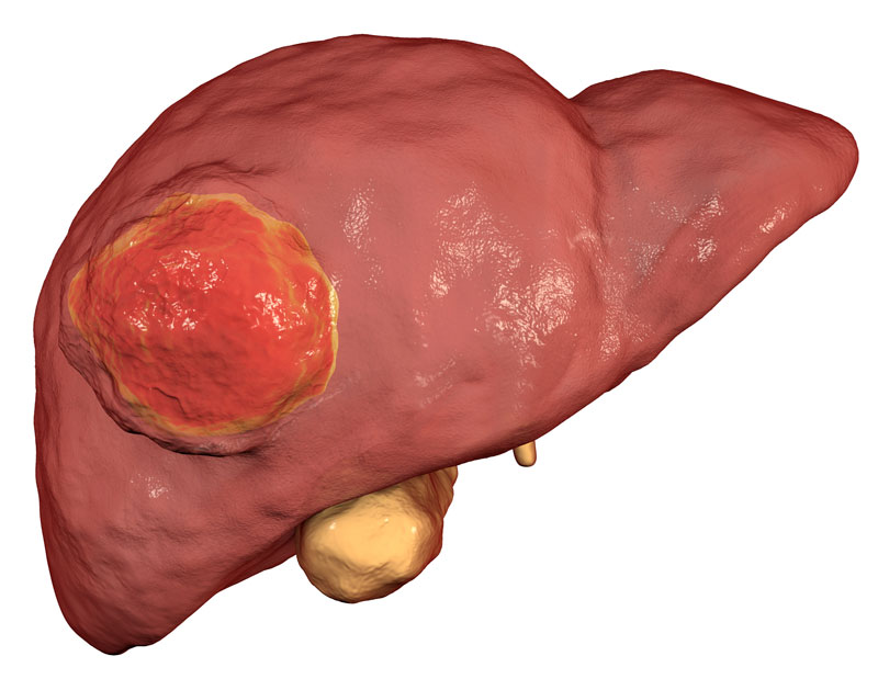 Liver Tumor Banner