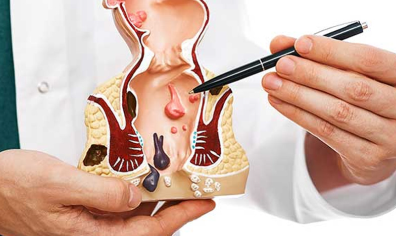 Advanced Proctology (Piles & Fistula Surgery)