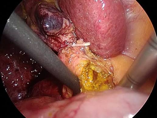Bile Duct Stone Surgery (Choledocholithotomy)