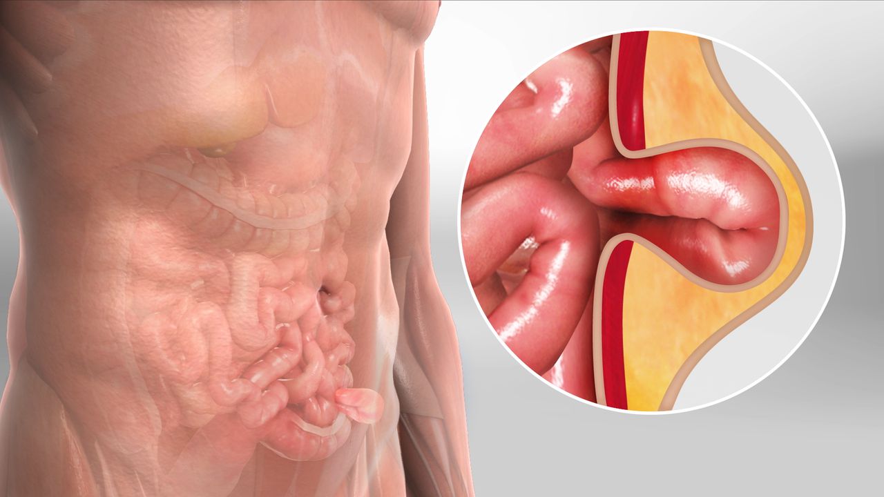 Hernia Repair