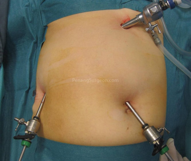 Laparoscopic Gallbladder Surgery (Cholecystectomy)