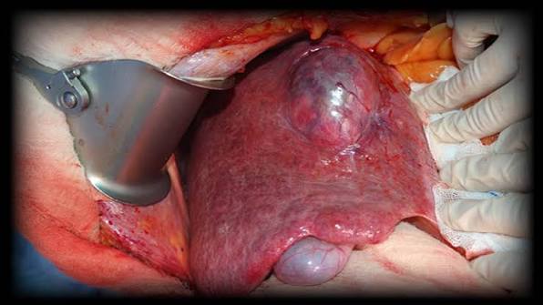 Liver Cyst, Tumor & Mass Removal