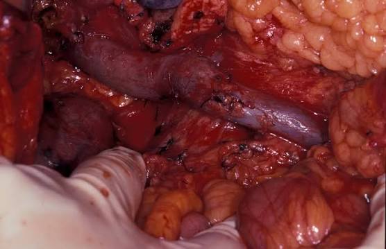 Pancreatic Surgery
