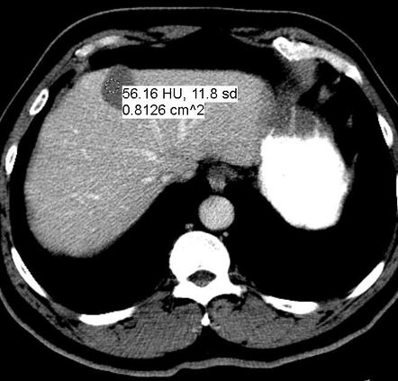 Liver Tumor Banner